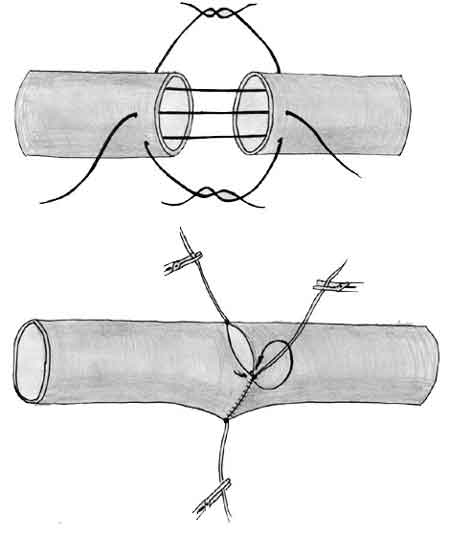 Отдельные моменты наложения сосудистого шва по Каррелю